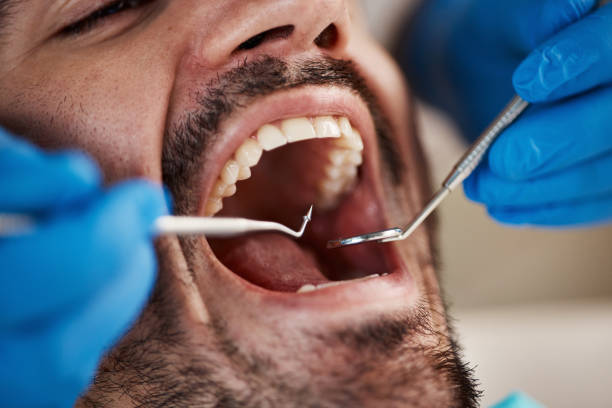 Best Emergency Treatment for Oral Infections in Gonzales, CA